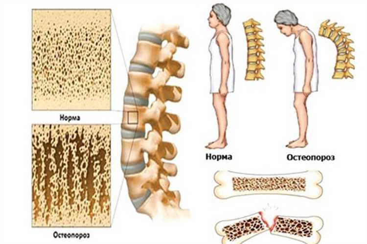 Prednisone Osteoporosis: Causes, Symptoms, and Treatment